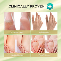 Vebuni Urea Cream foot application demonstrates callus-softening on feet.