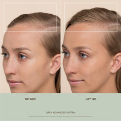 VEGAMOUR GRO+ 0.25mm needles detail shows precise exfoliation for better absorption.