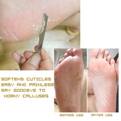 WANLIAN oblique knife targets nail grooves and minor ingrown areas