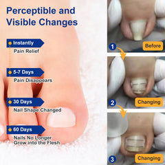 Yanxifei nickel-titanium memory wire corrector — lifts the nail away from the skin, potentially reducing discomfort.