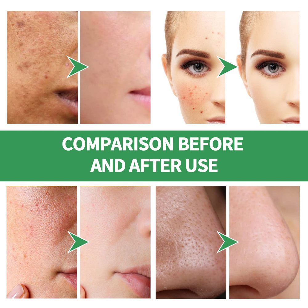 Aacnre Centella bubble facial mask application on clean skin