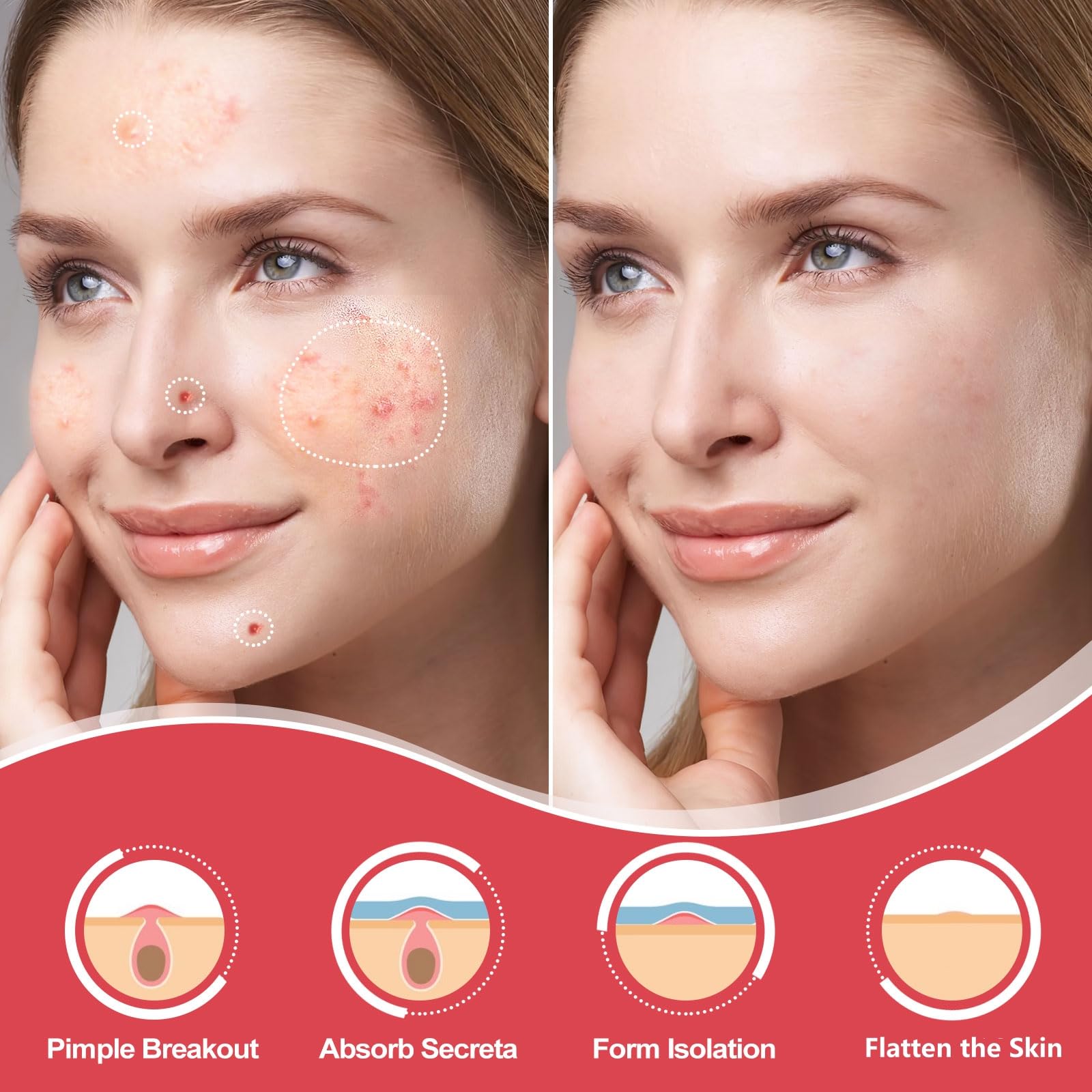 AcneGo hydrocolloid patch pack shown, breathable and skin-friendly for daily wear.