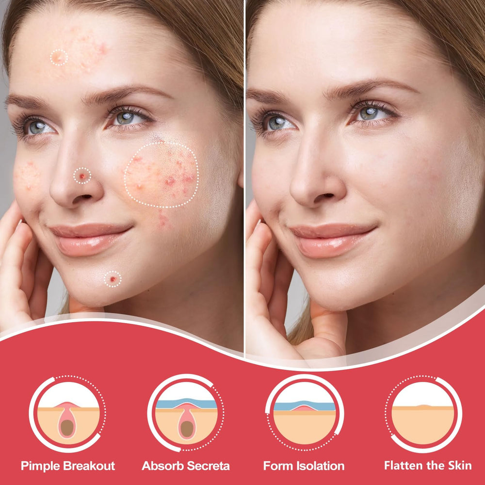 AcneGo hydrocolloid patch pack shown, breathable and skin-friendly for daily wear.