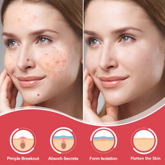 AcneGo hydrocolloid patch pack shown, breathable and skin-friendly for daily wear.