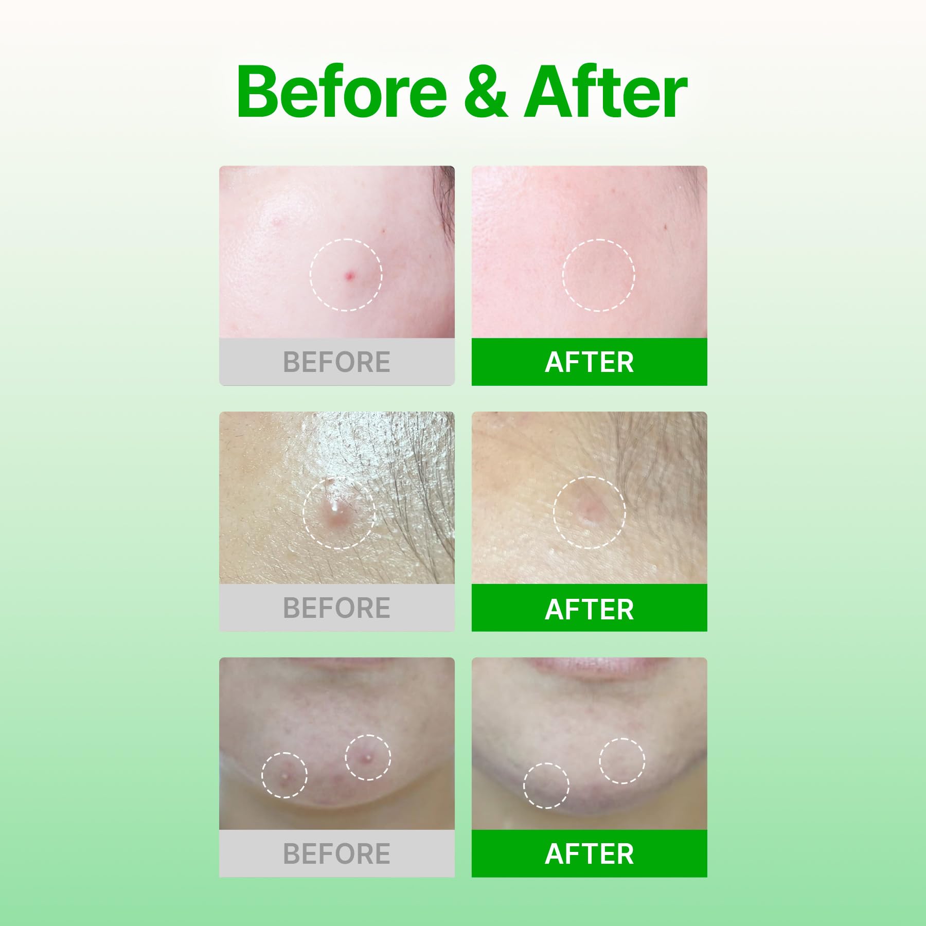 Acropass patch with hydrocolloid layer providing protective barrier for skin.