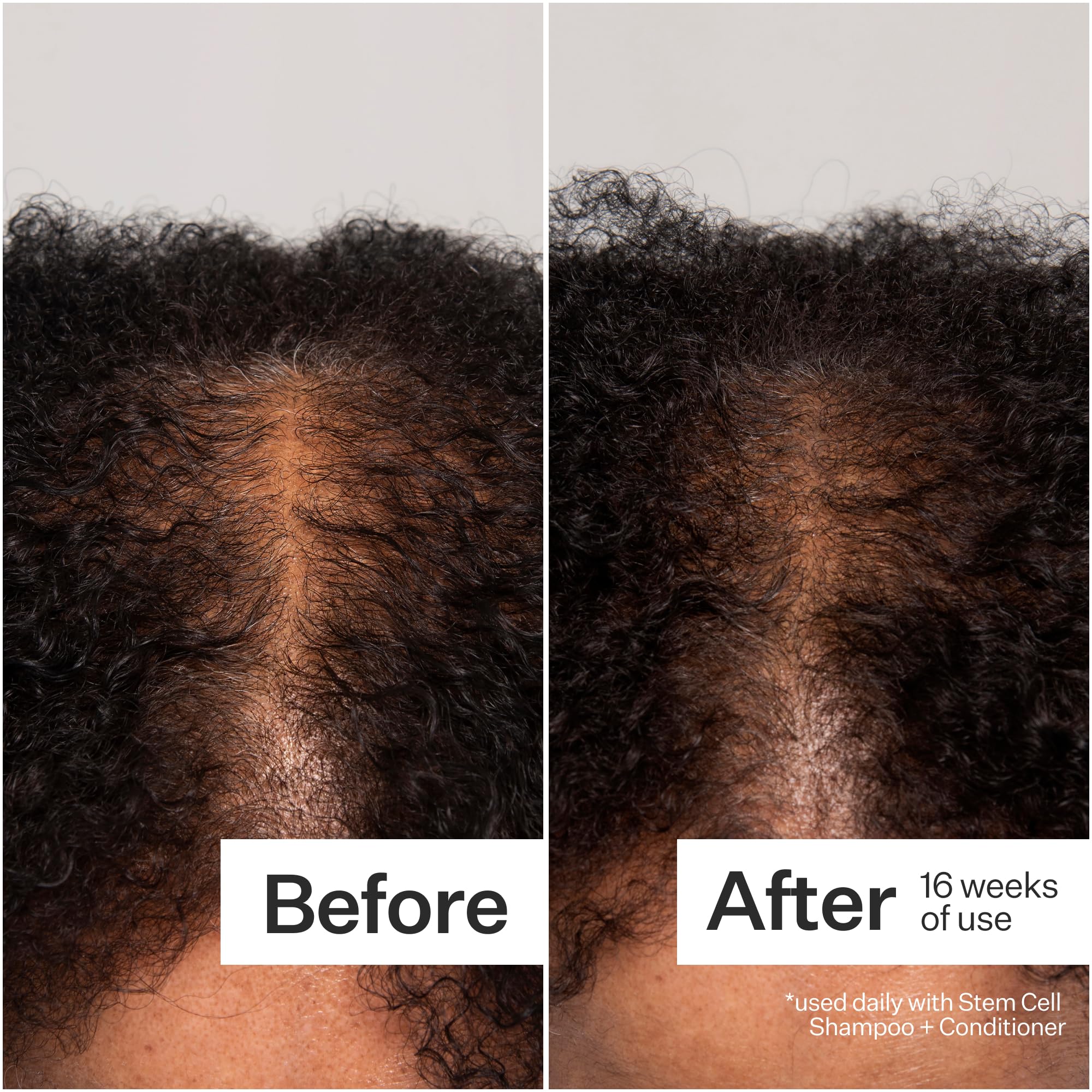 ACT+ ACRE damp scalp application demonstrates easy daily routine