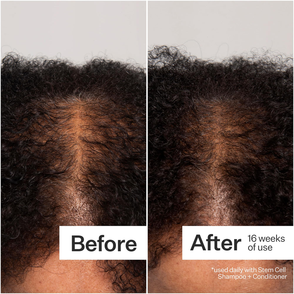 ACT+ ACRE damp scalp application demonstrates easy daily routine