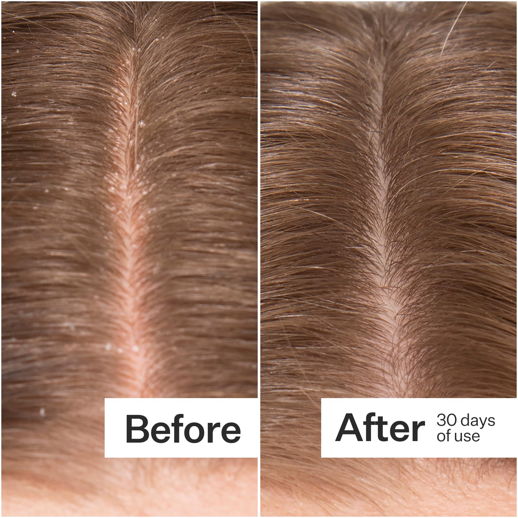ACT+ ACRE Microbiome Cooling Scalp Serum pipettes demonstrate targeted application