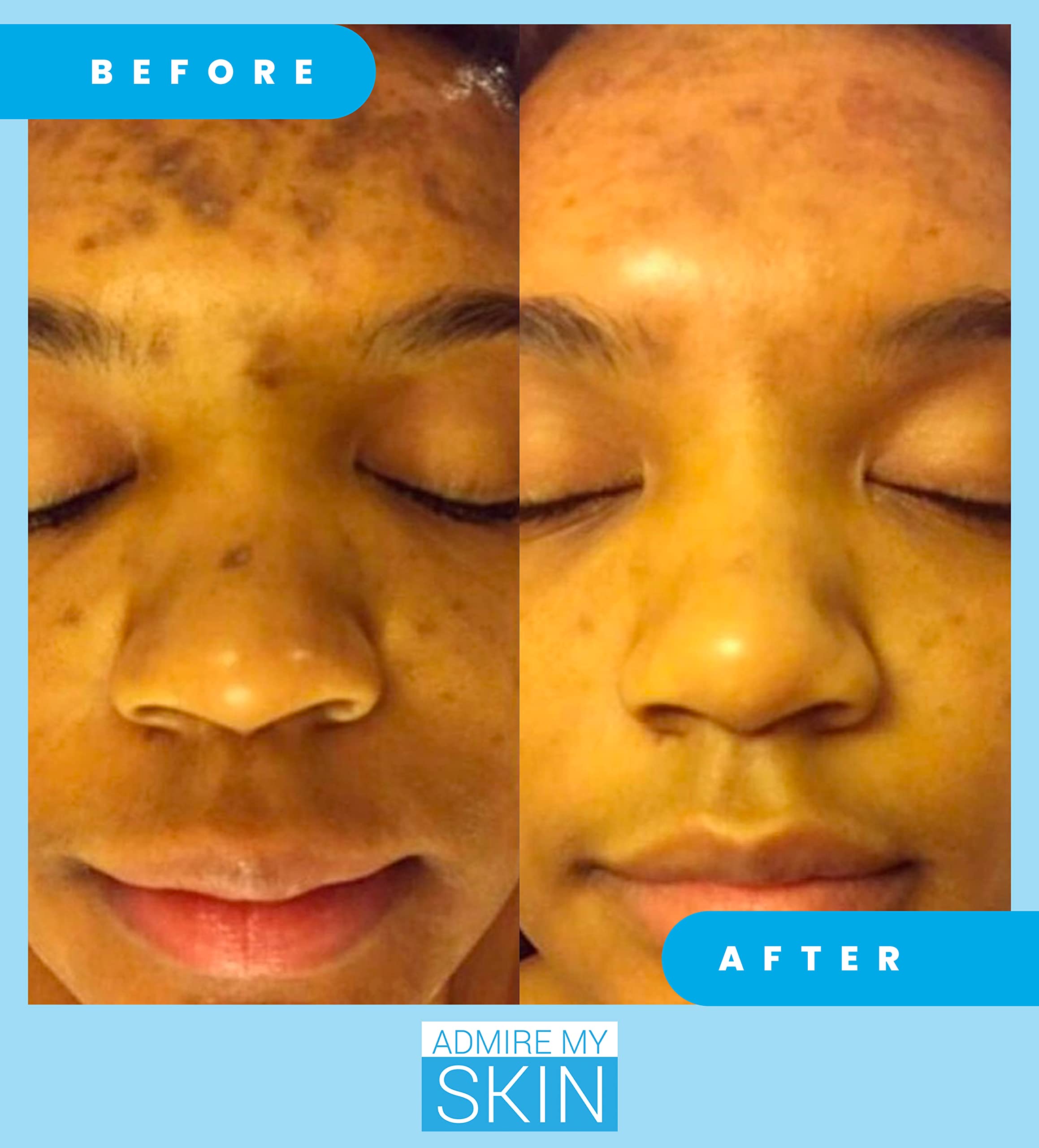 Admire My Skin kojic and azelaic acids graphic illustrating gentle discoloration correction.