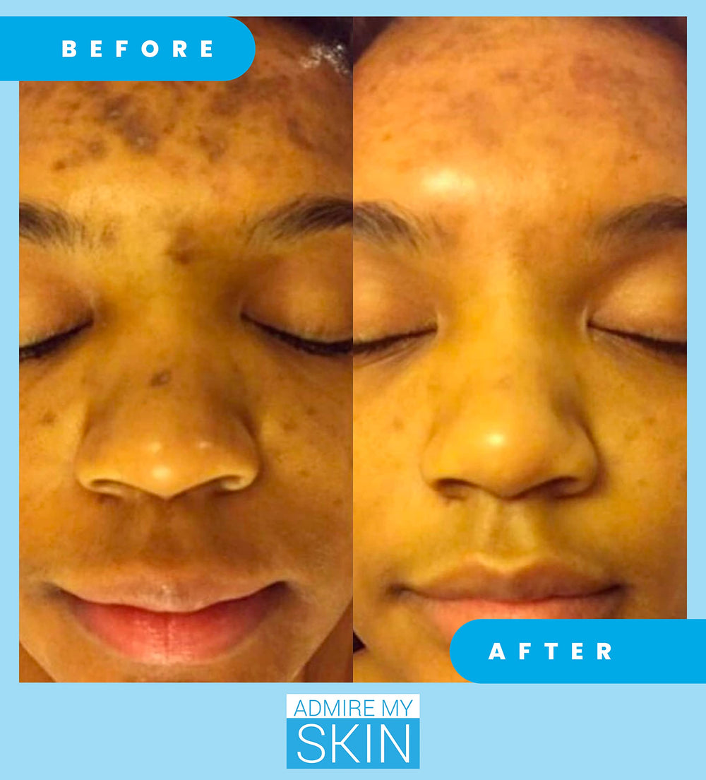 Admire My Skin kojic and azelaic acids graphic illustrating gentle discoloration correction.