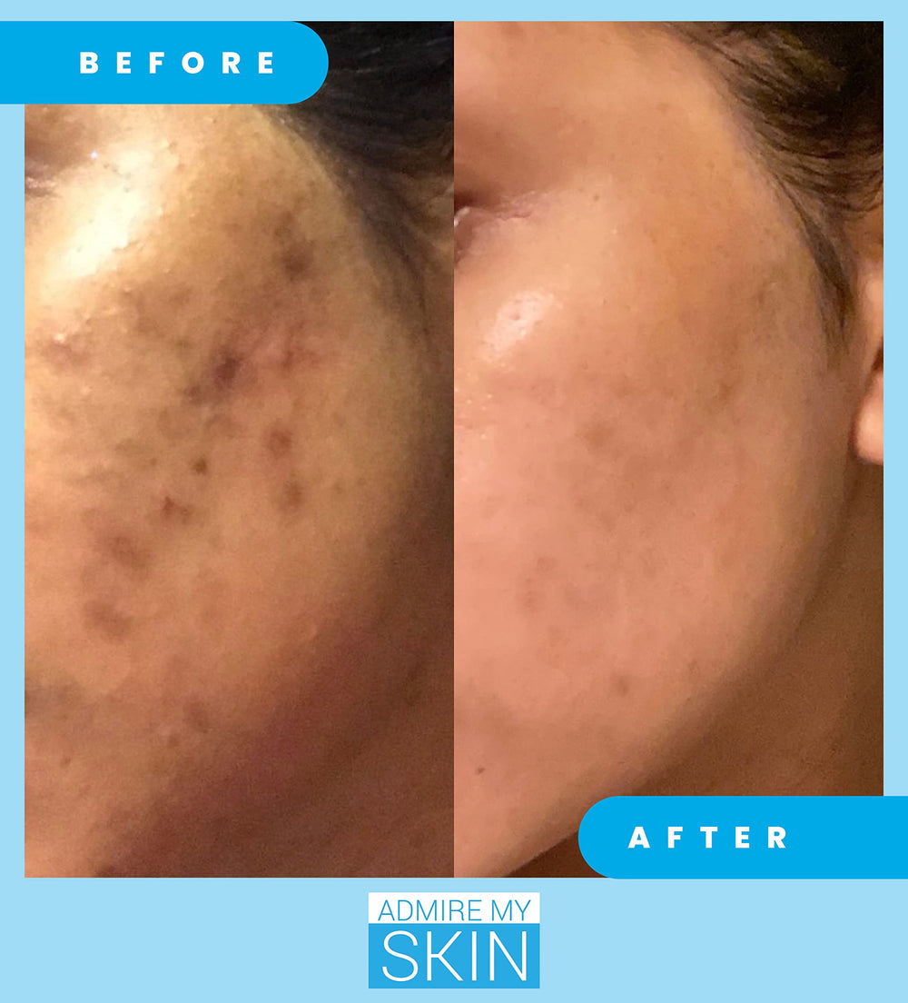 Admire My Skin melasma-prone cheek close-up highlighting targeted treatment area.
