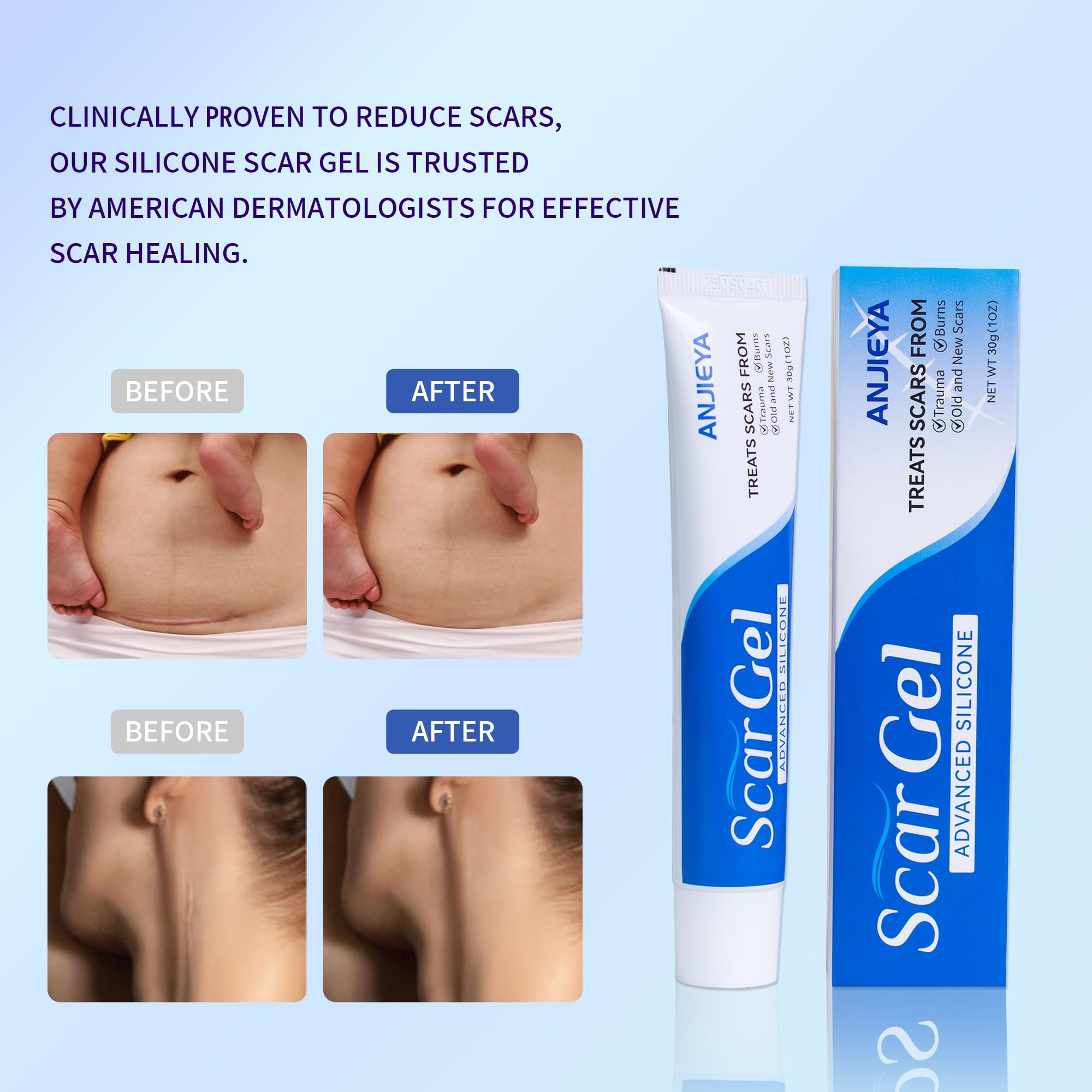 ANJIEYA silicone scar gel packaging shown for easy travel scar care.