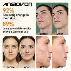ANSIOVON blue-light therapy device handheld design shown for easy facial spot treatment at home.