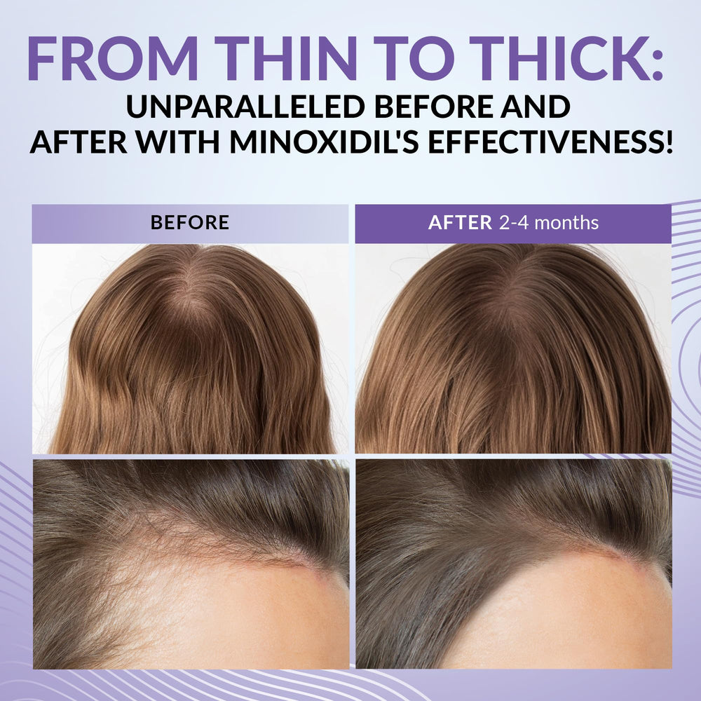 ANTROLIFE Minoxidil 2% ingredients scene shows biotin, ginseng, and ginger.