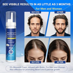 AOOLCF minoxidil foam texture close-up shows easy, non-irritating application.