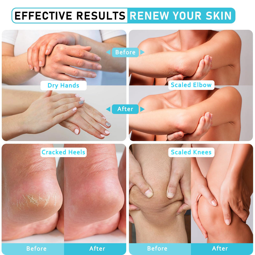 Aphesia Urea Cream 40% elbow application demonstrates versatile body use.