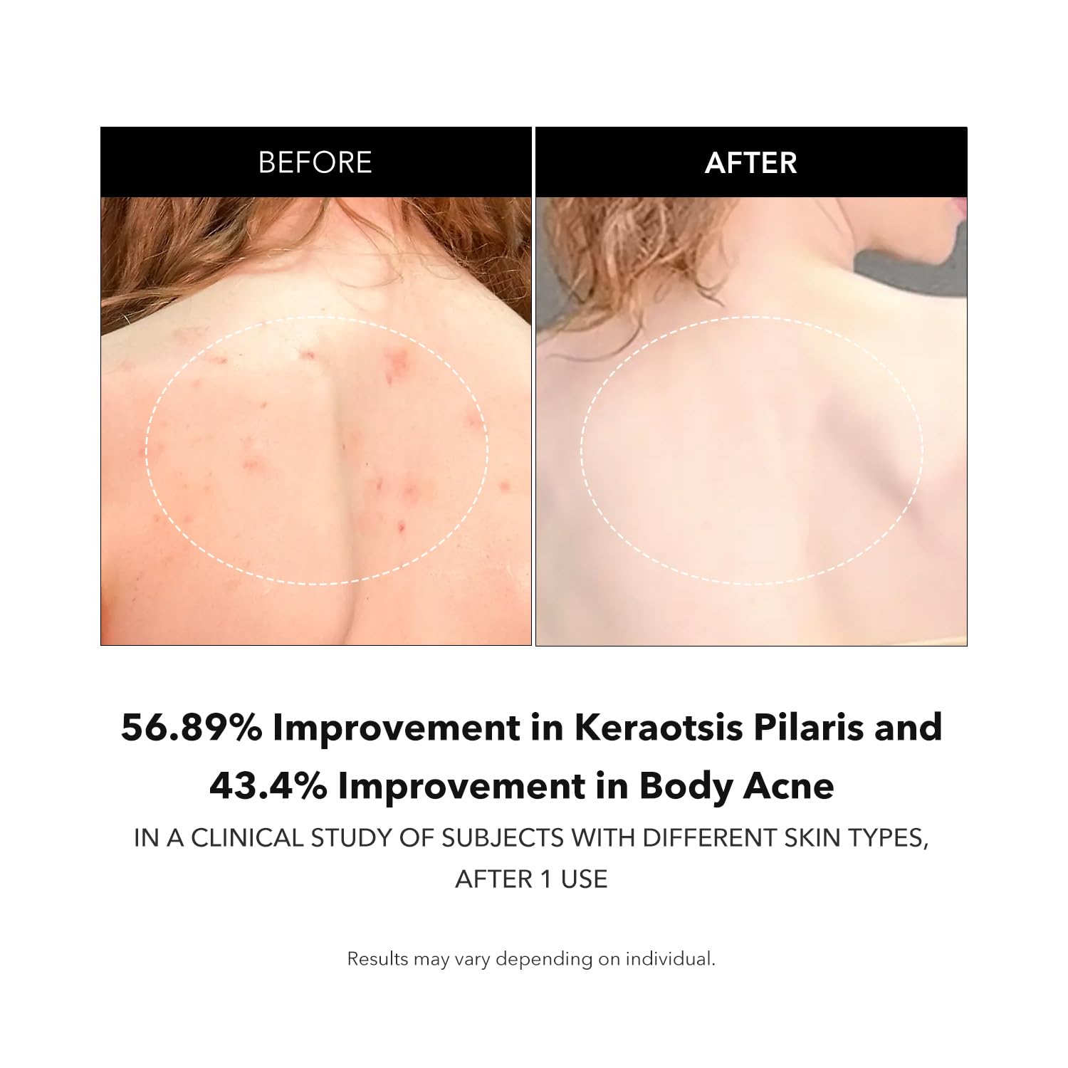 Targeted KP texture with APRILSKIN Carrotene IPMP Exfoliating Body Wash