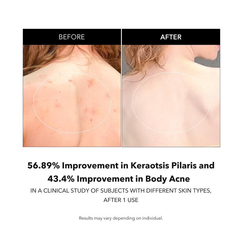 Targeted KP texture with APRILSKIN Carrotene IPMP Exfoliating Body Wash