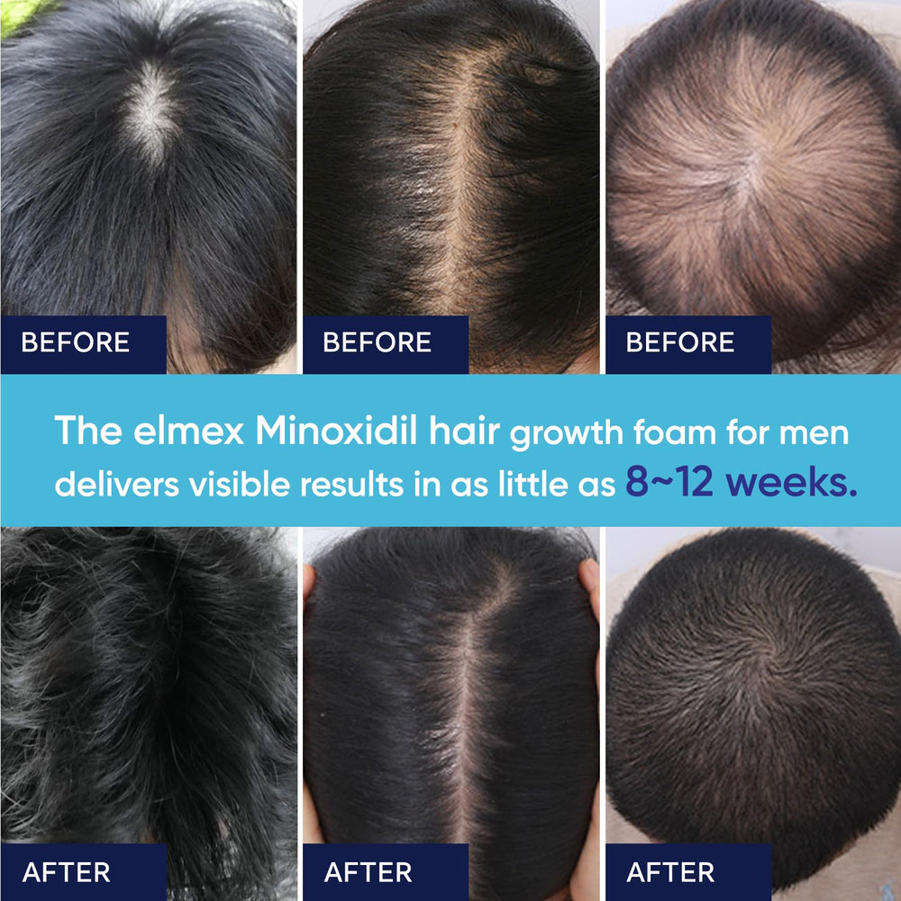 Artimore Minoxidil Foam with biotin, castor oil, and collagen ingredients.
