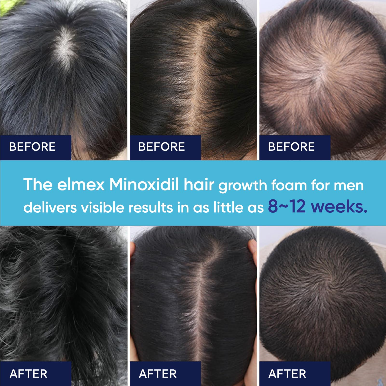 Artimore Minoxidil Foam packaging with product details.