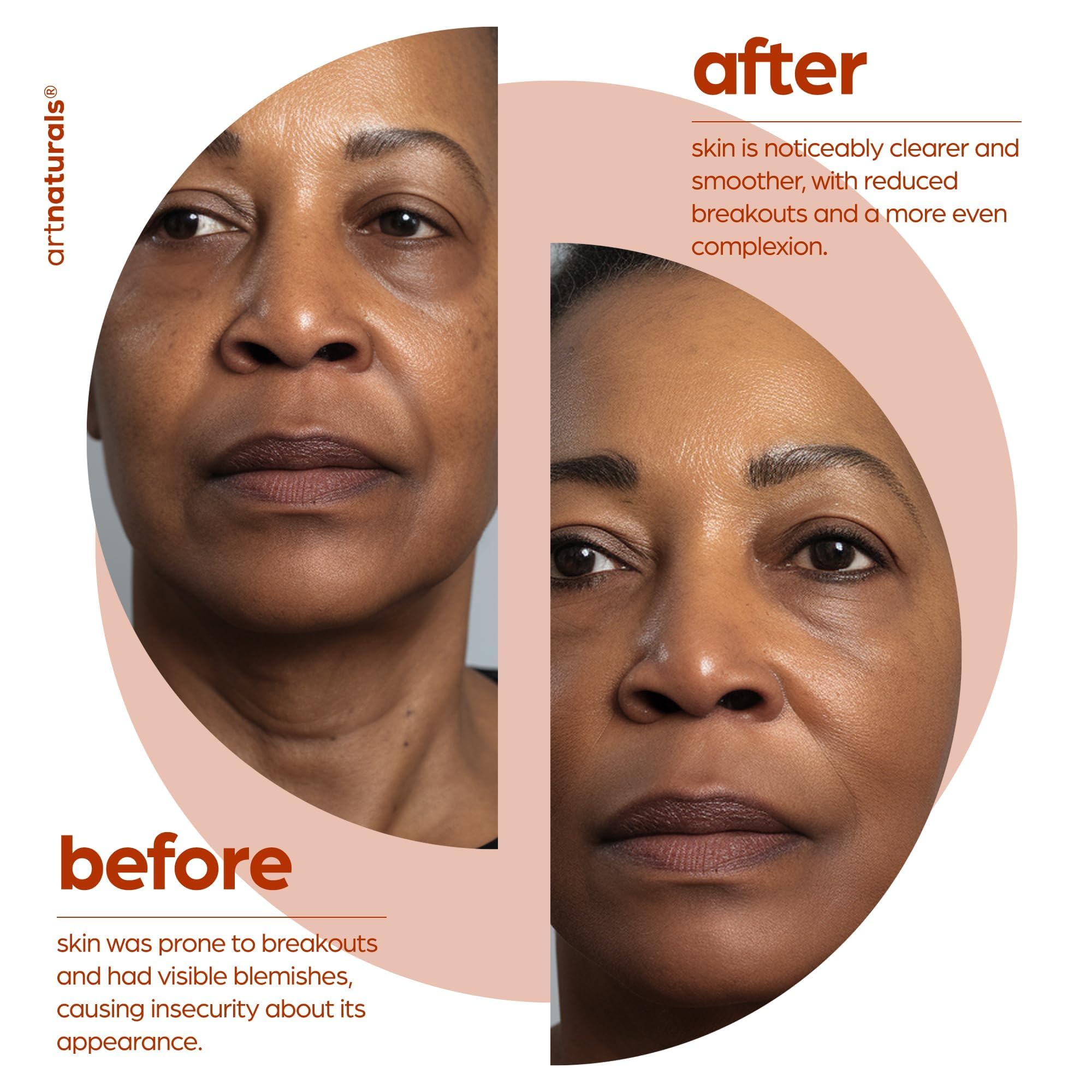 artnaturals Salicylic acid Serum on skin after use suggesting a fresh, brighter look.
