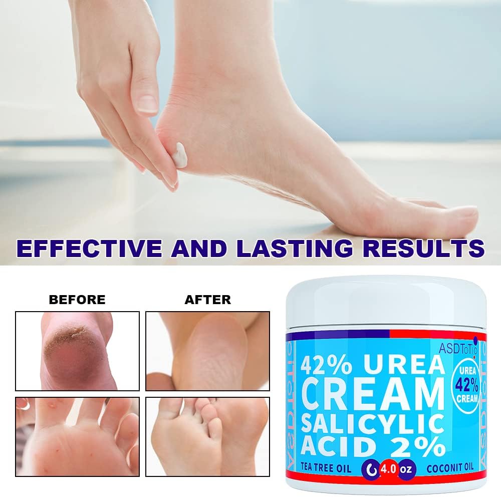 Applying ASDToTio Urea Cream to the foot before bed
