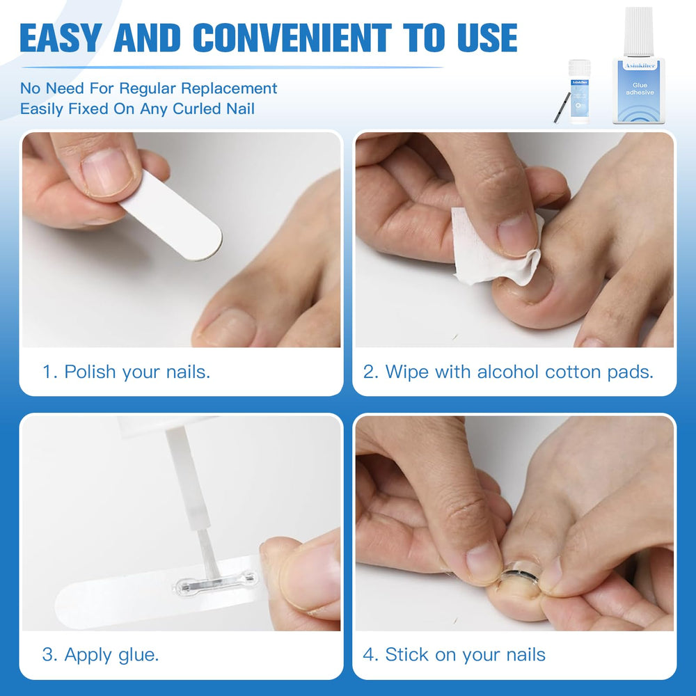Asinkiher memory-function titanium alloy offers gentle, controlled nail correction