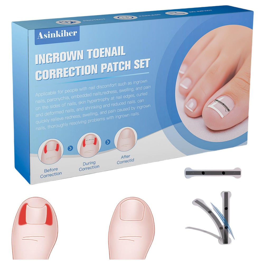 Asinkiher titanium alloy ingrown toenail corrector with 0-59 inch size for precise correction