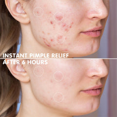 AUSLKA Star Pimple Patches being applied to a blemish for targeted care.