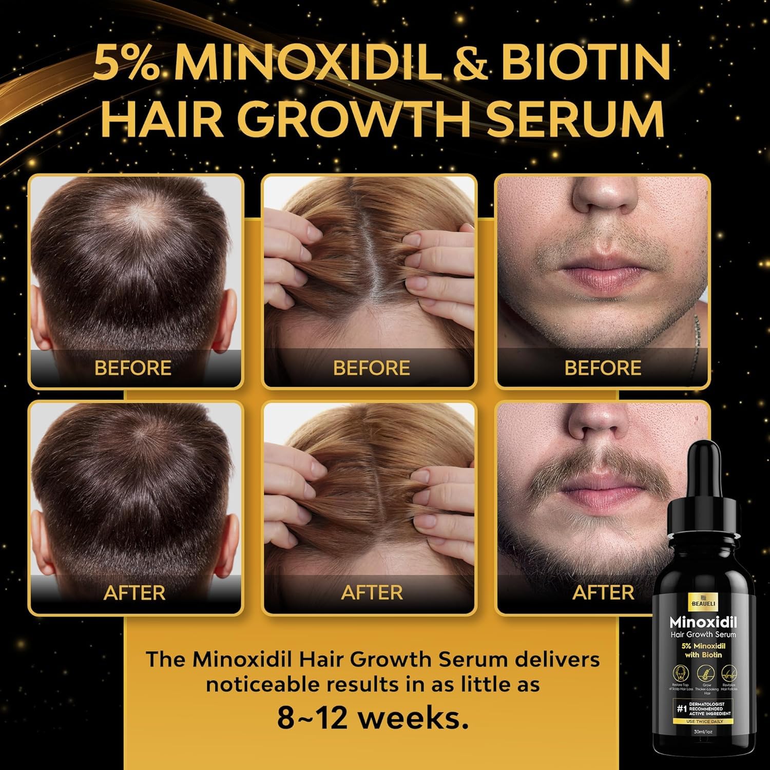 Beaueli 5% Minoxidil bottle dropper shows precise application for targeted use.