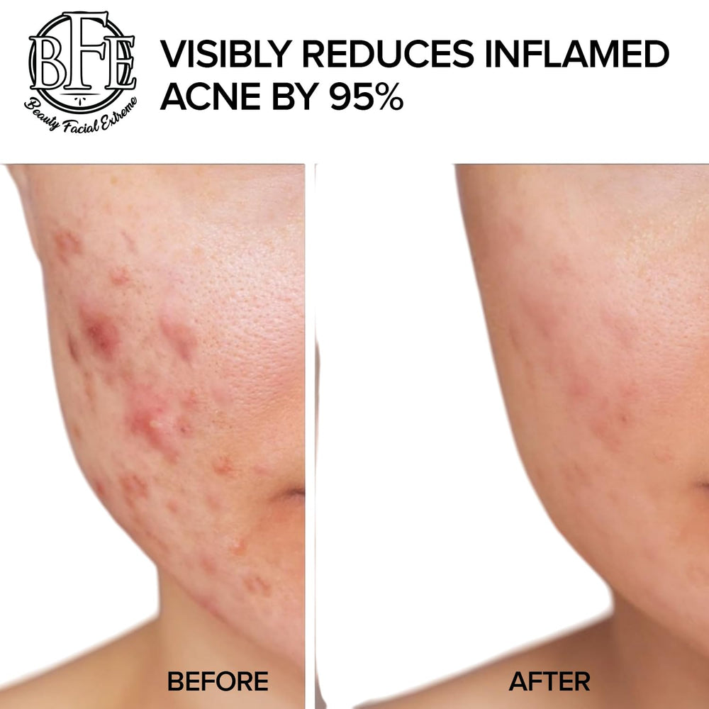 Beauty Facial Extreme acne pad dark-spots image hints at improved skin tone over time