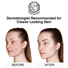 Beauty Facial Extreme acne pad packaging showcases botanically infused formula for daily acne care