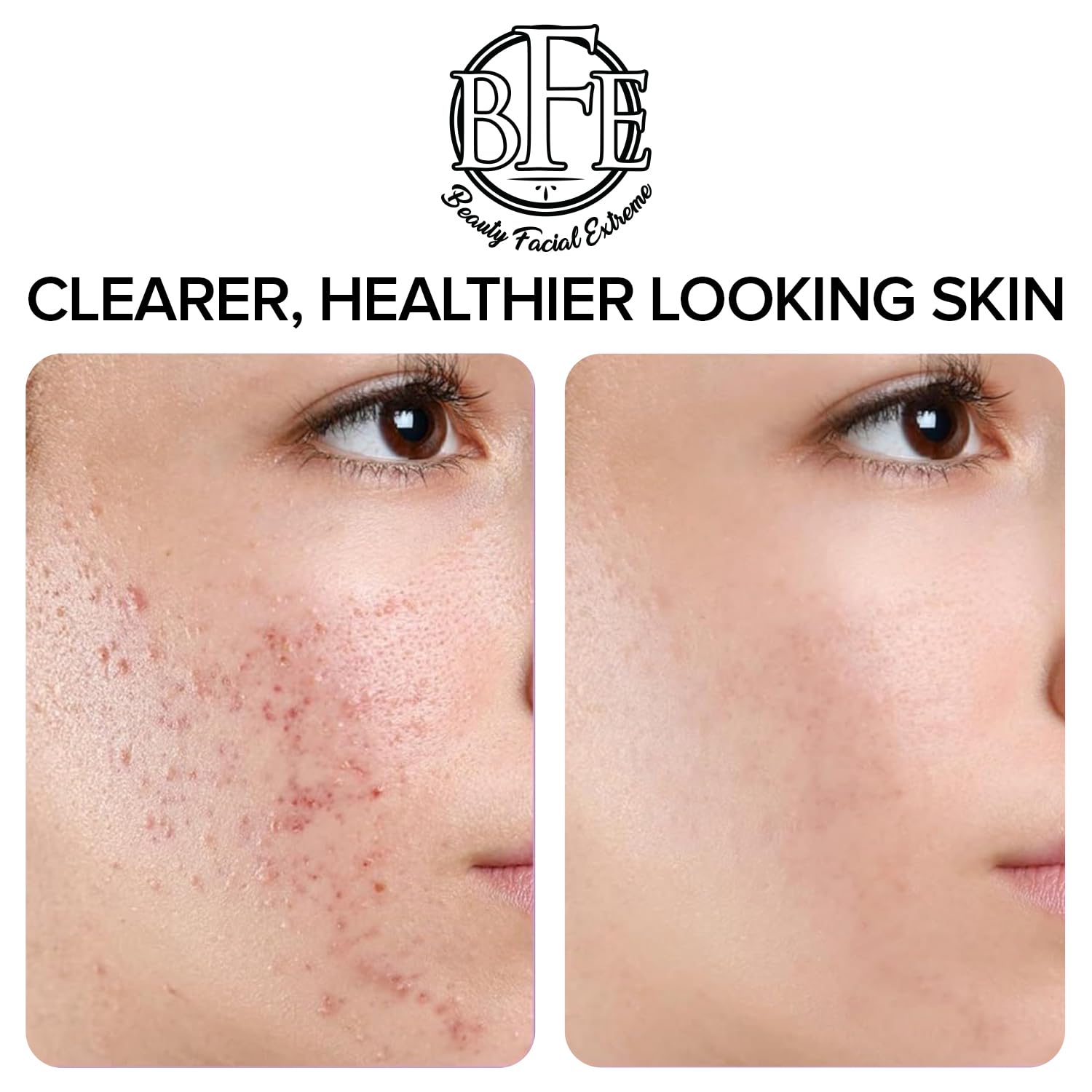Beauty Facial Extreme acne pad whitehead target demonstrates potential breakout relief