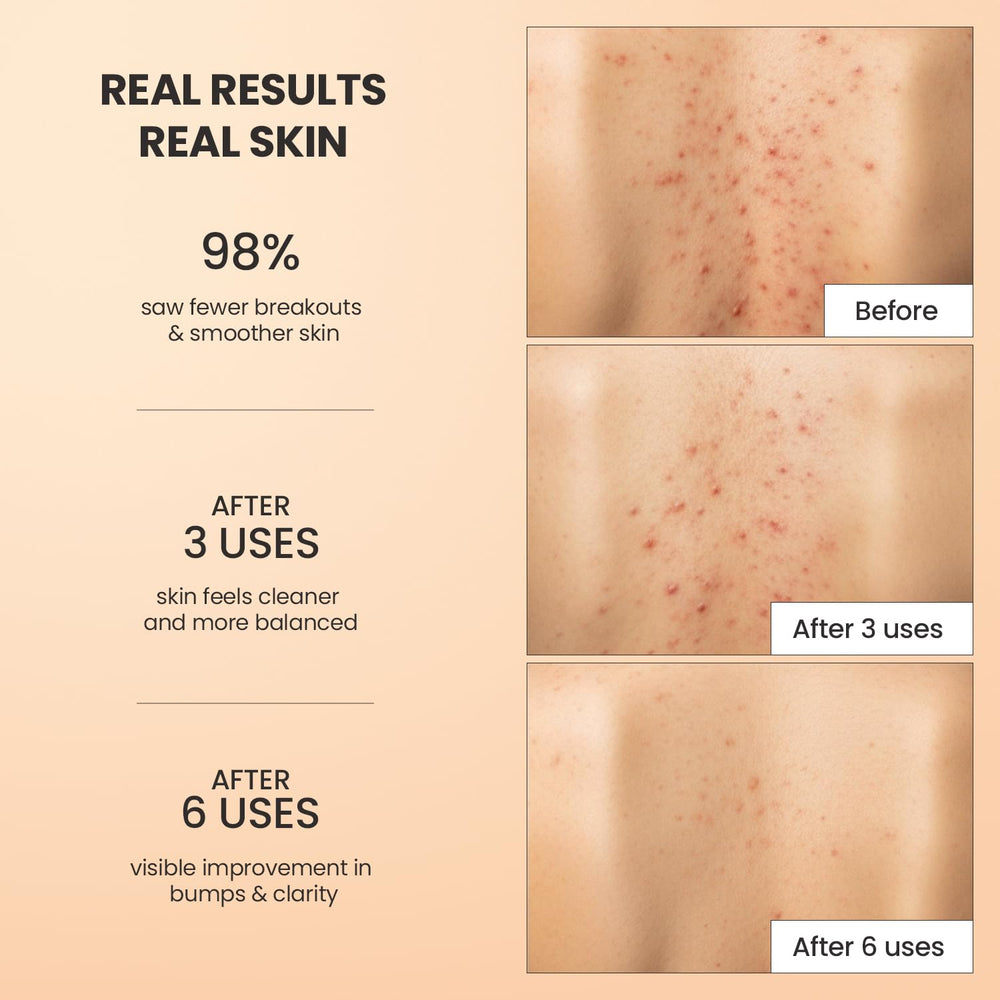 BellamiLuxx Back acne area treatment in use on the back with visible smoother texture.