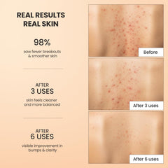 BellamiLuxx Back acne area treatment in use on the back with visible smoother texture.