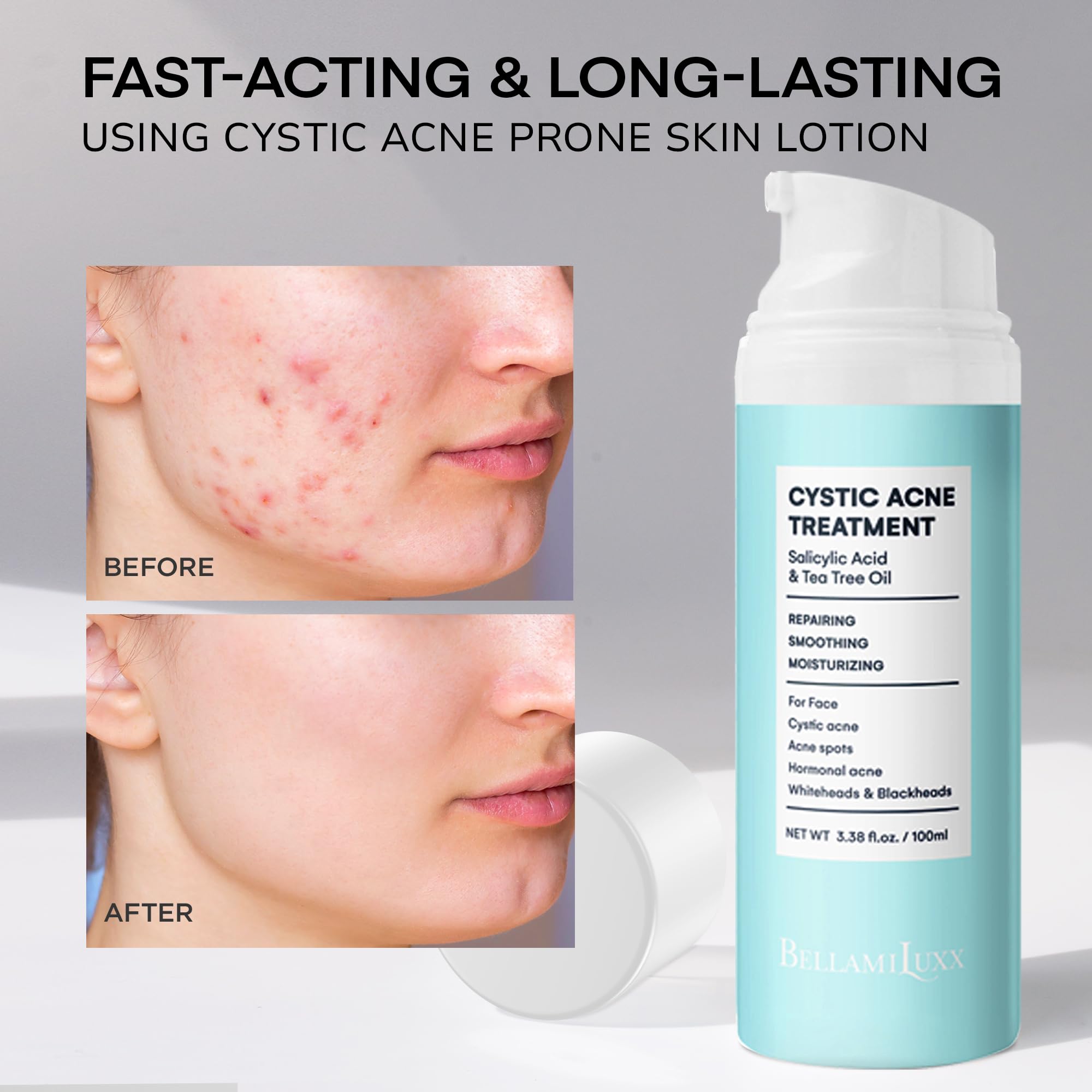 BellamiLuxx hormonal teen acne use shows suitability for teens and adults.