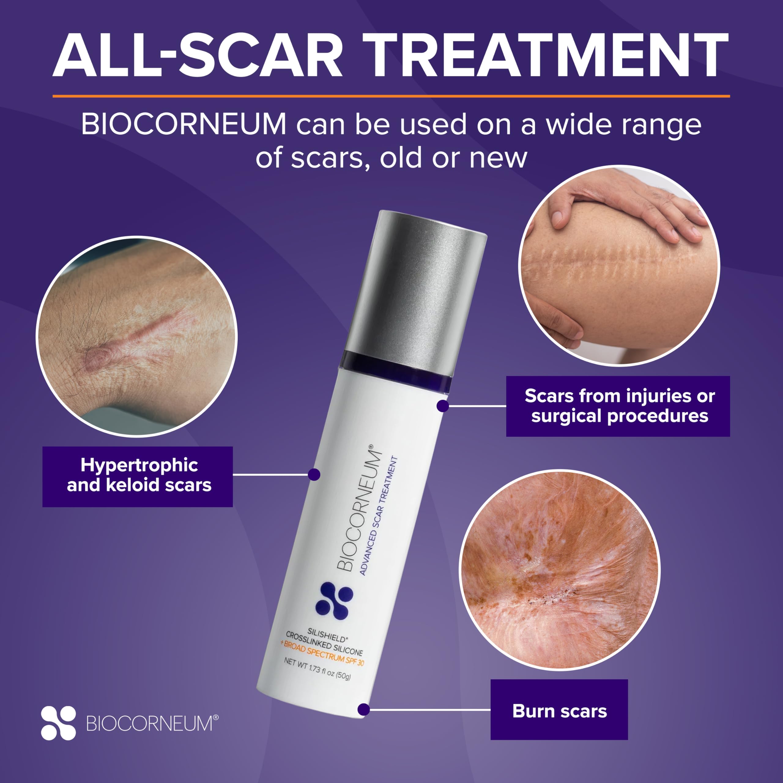 Biocorneum gel applied to skin after burns or injuries
