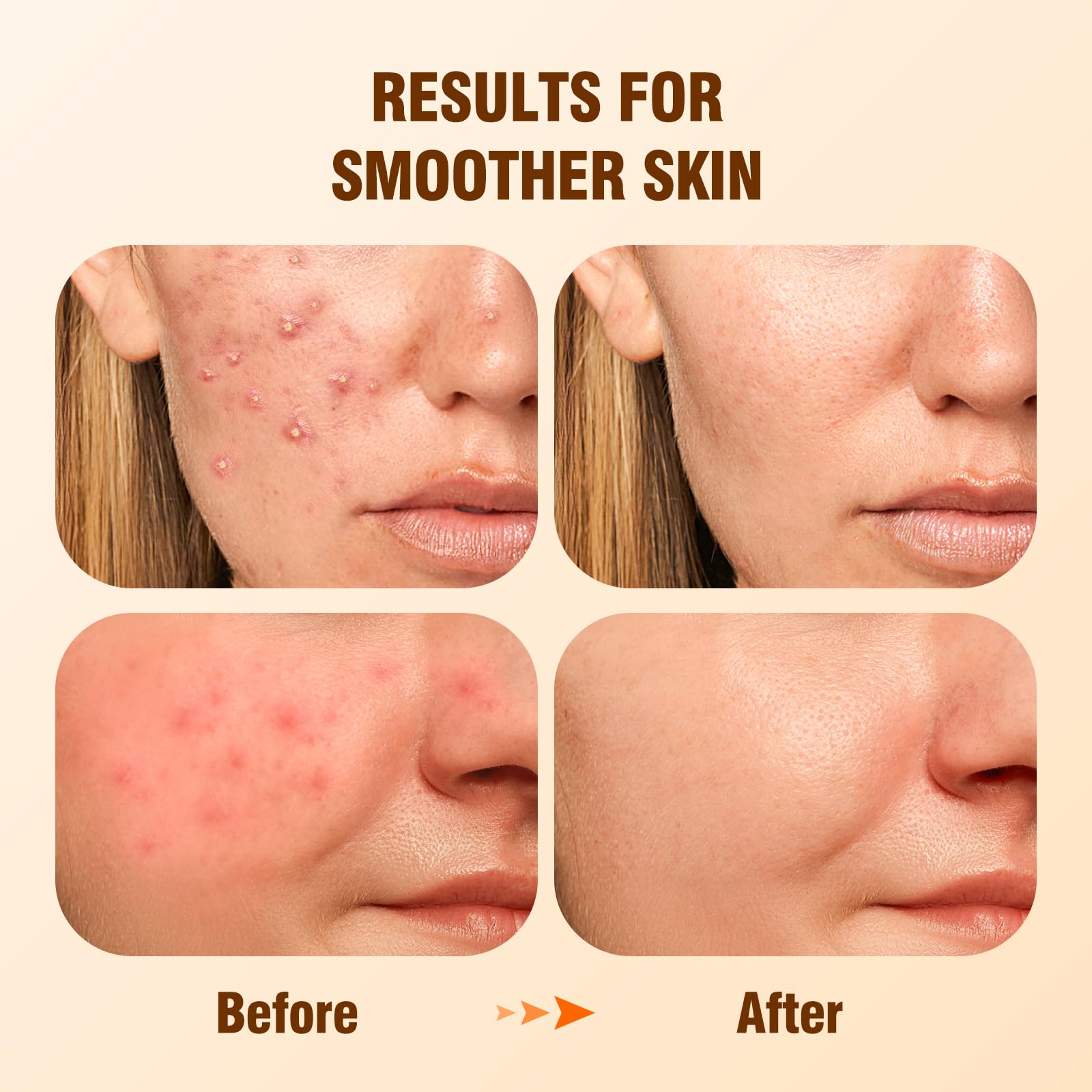 BIYSBER salicylic acid serum dropper demonstrates precise application for gentle exfoliation.