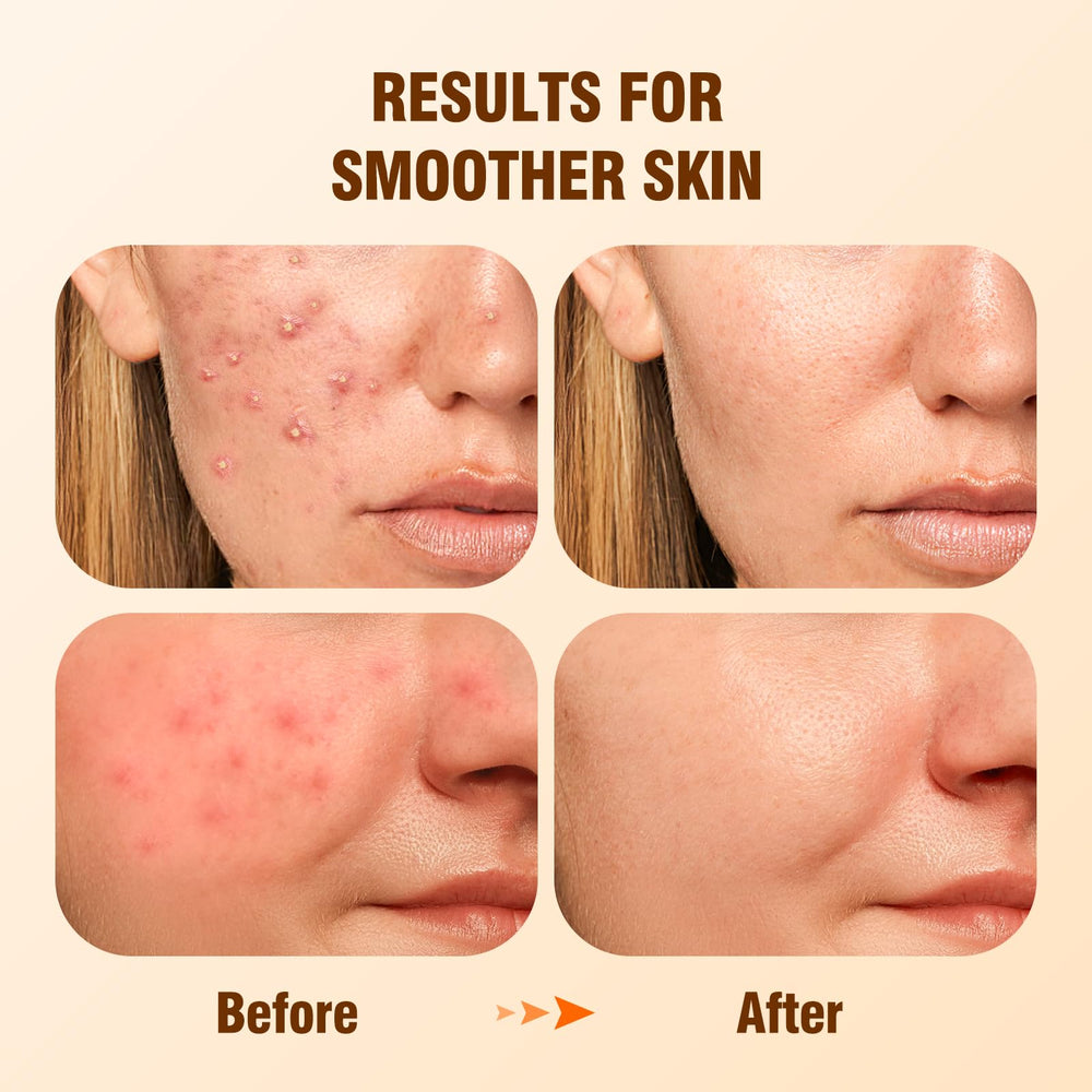 BIYSBER salicylic acid serum dropper demonstrates precise application for gentle exfoliation.