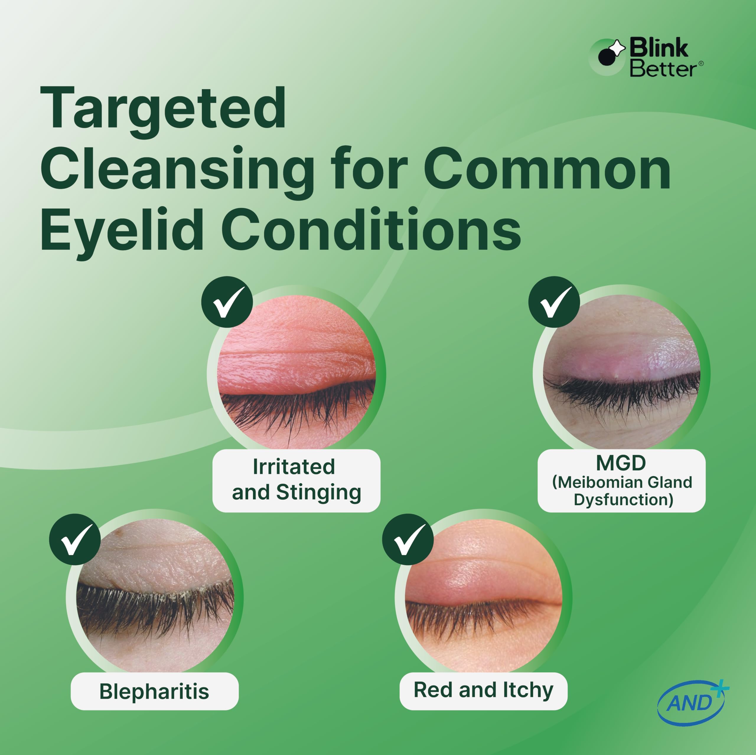 BlinkBetter BetterLids Gel application on the palm demonstrates easy, soothing cleansing routine