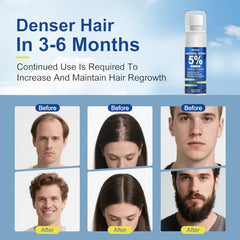BLIYEOGZ minoxidil spray on scalp illustrates direct application to thinning areas.