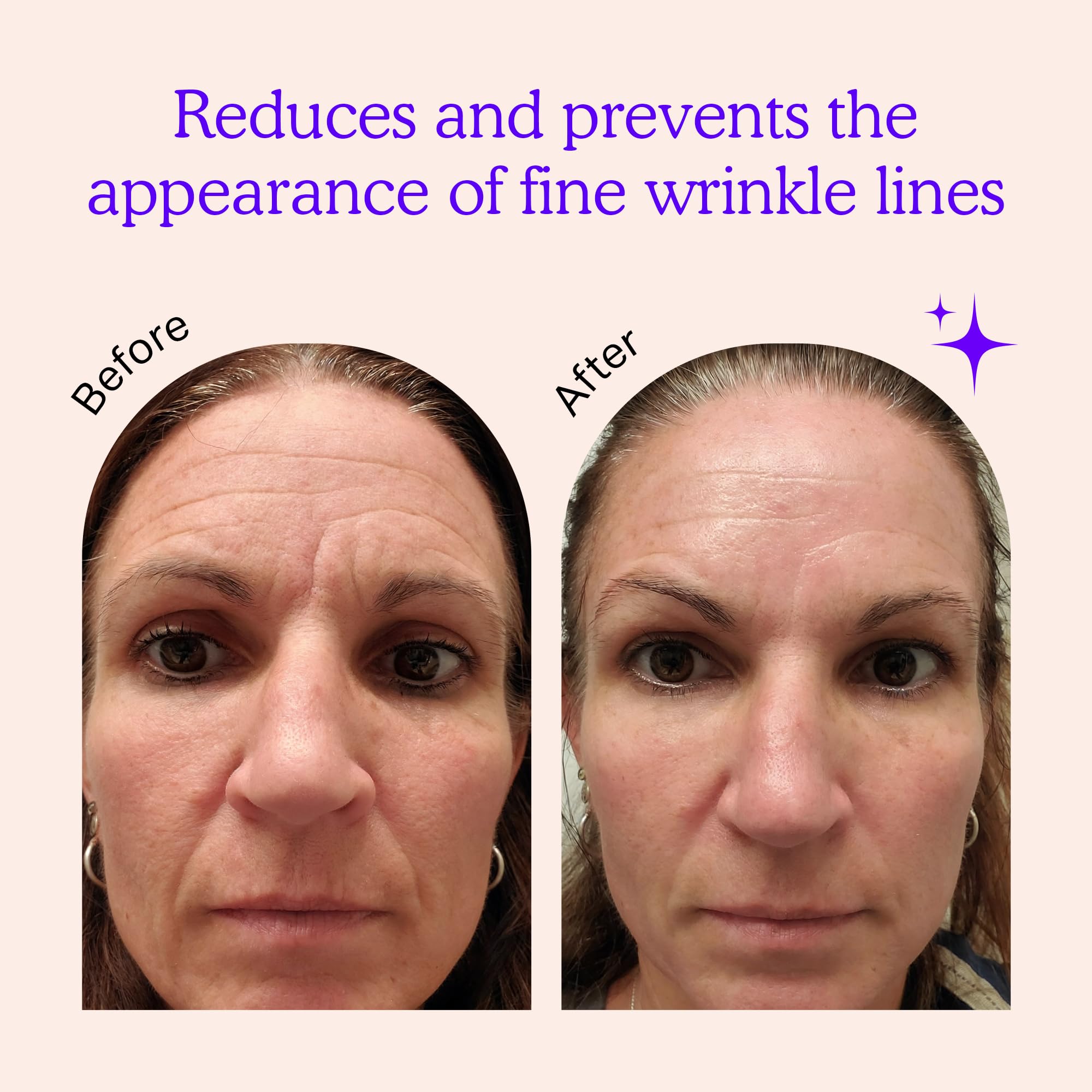 BLUMBODY forehead patch on skin highlights non-silicone, comfortable wear for forehead lines.