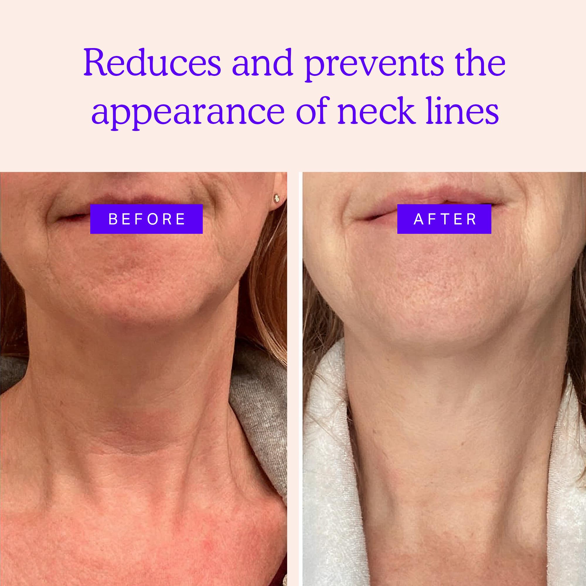 BLUMBODY Neck Wrinkle Patches closeup of silicone texture for skin-friendly use