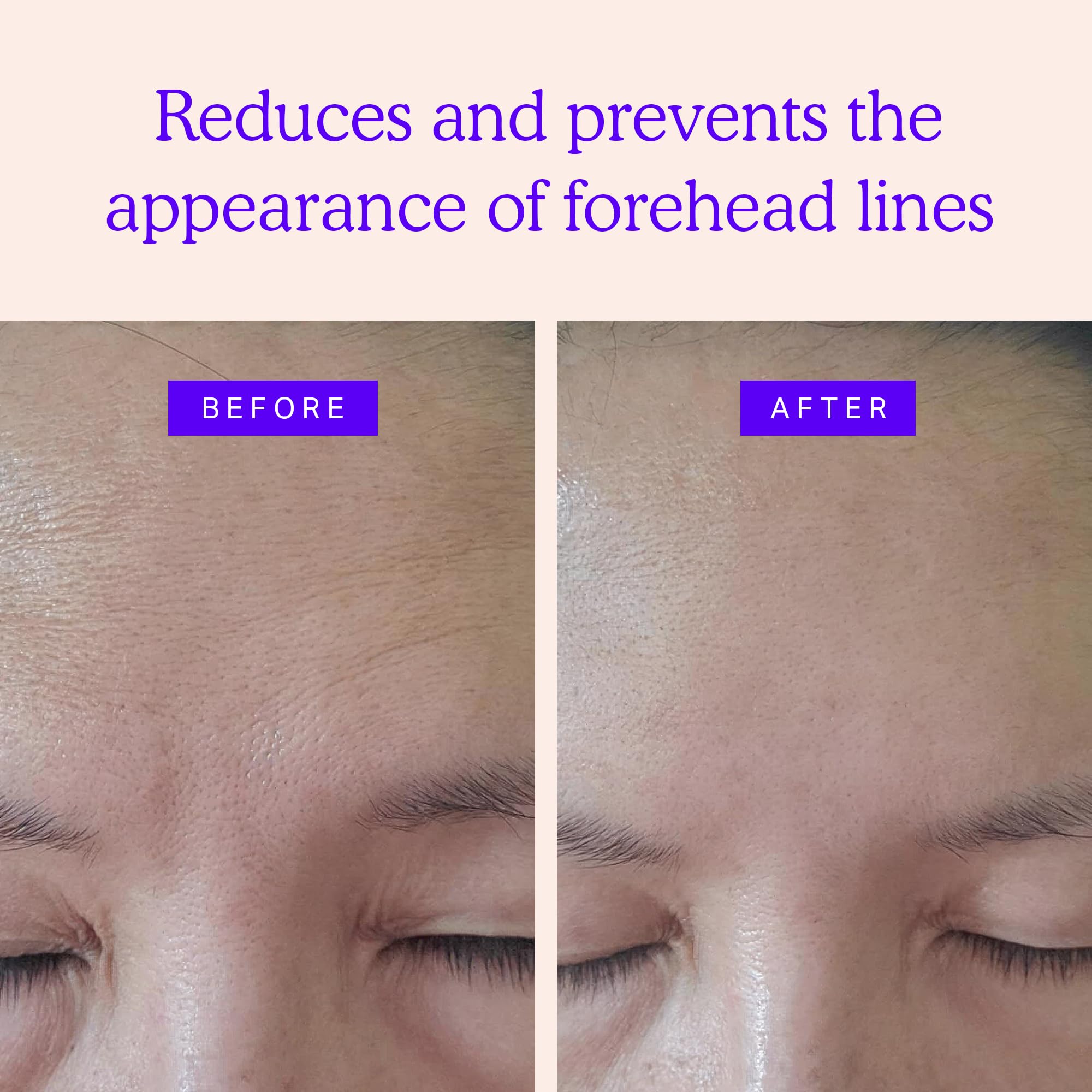 BLUMBODY forehead wrinkle patches on skin show thin, discreet wear.