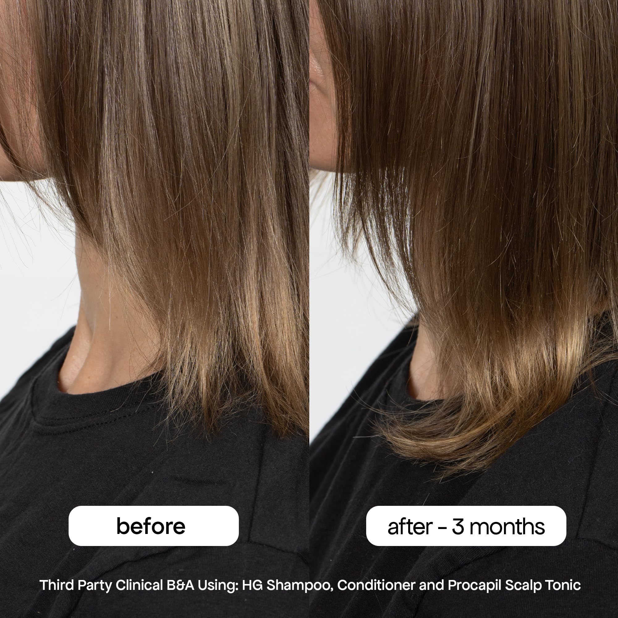 BondiBoost HG Shampoo clinical results graph illustrating reduced shedding