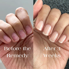 Botanist Nails The Remedy nails before image shows damaged tips
