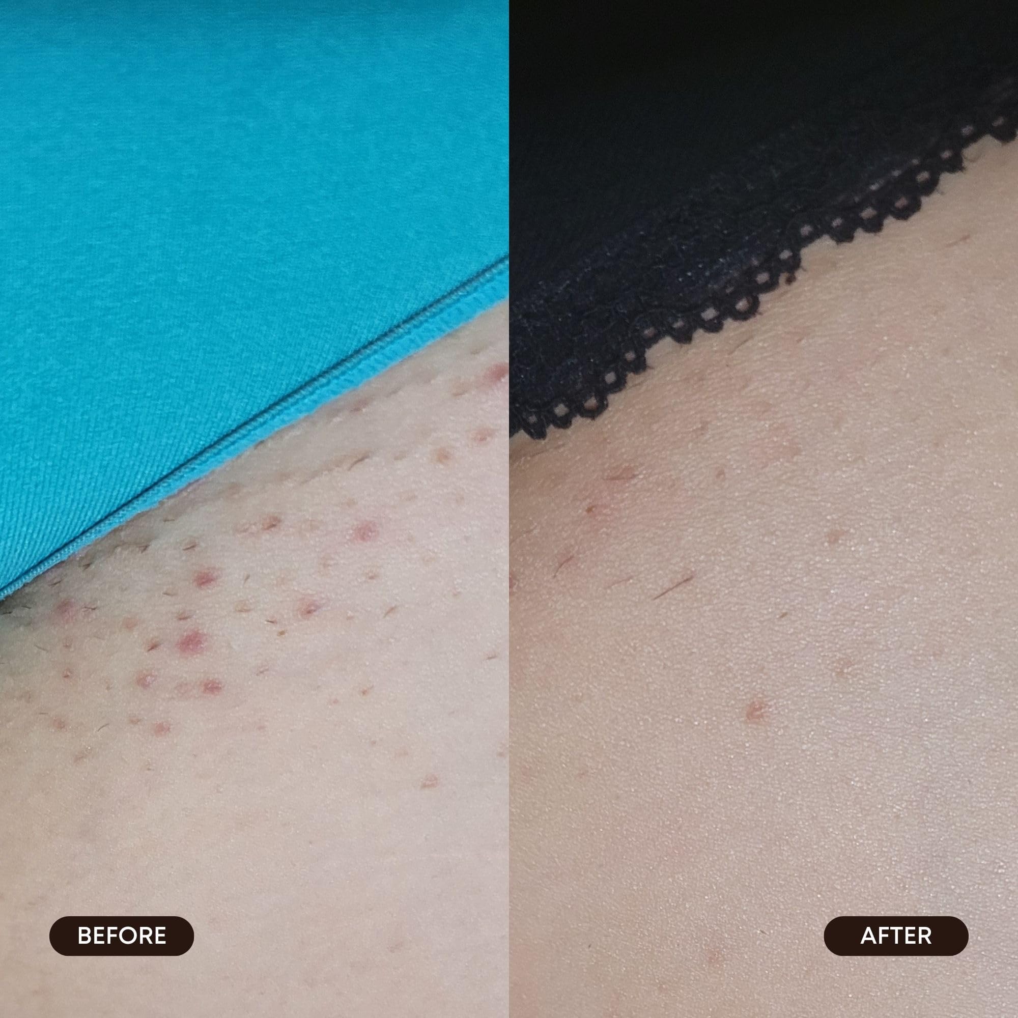 Bushbalm pad applied to bikini area for gentle exfoliation