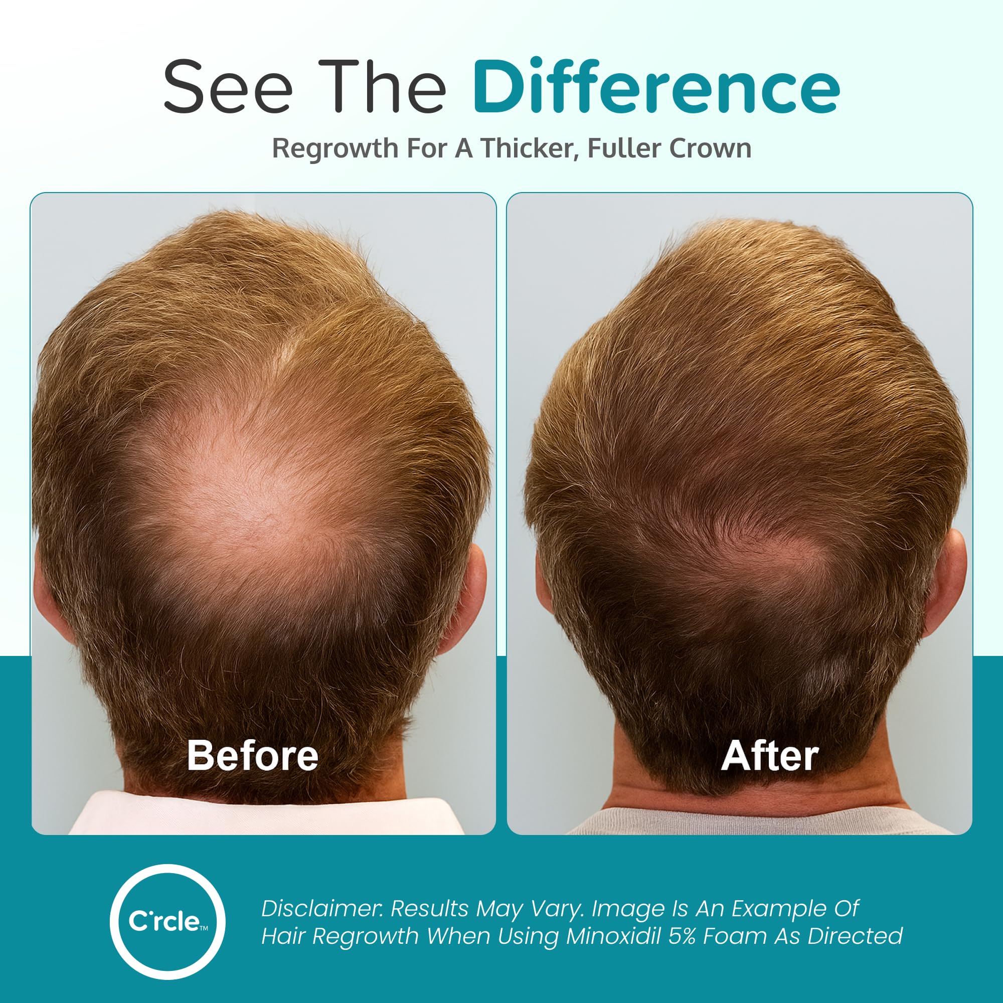 Close-up of C'rcle Minoxidil foam texture for comfortable use