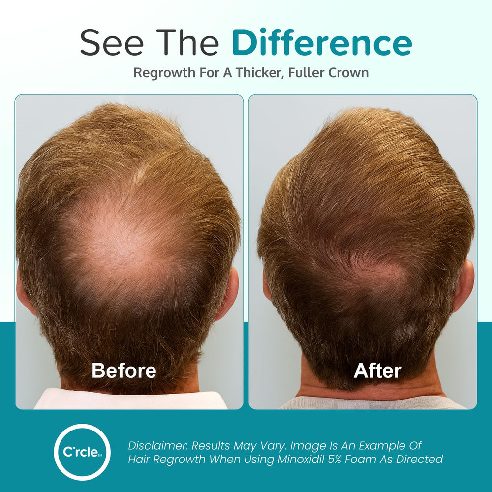 Close-up of C'rcle Minoxidil foam texture for comfortable use