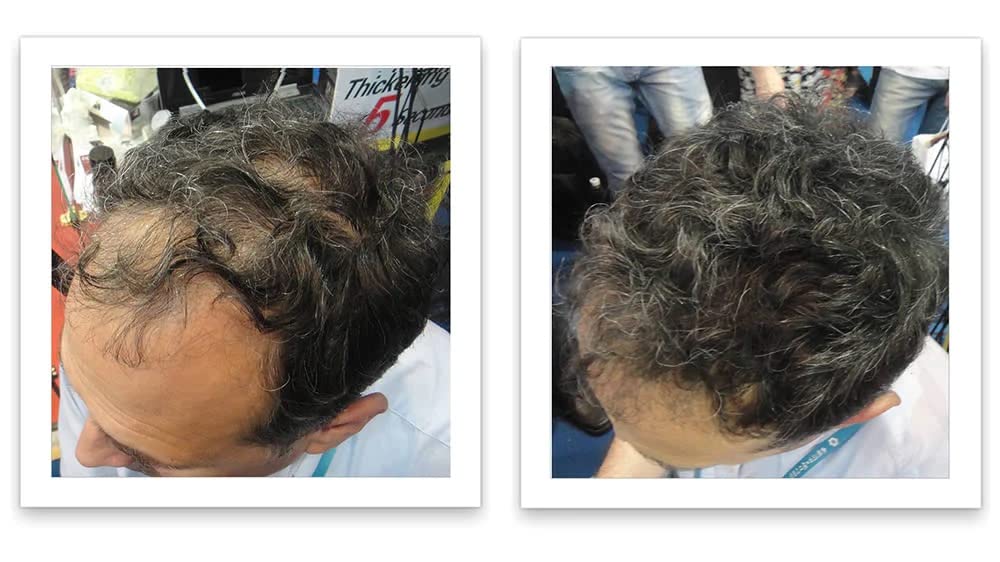 Caboki bald-spot elimination visuals show seamless blend with surrounding hair.